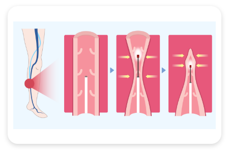 레이저(정맥폐쇄술)