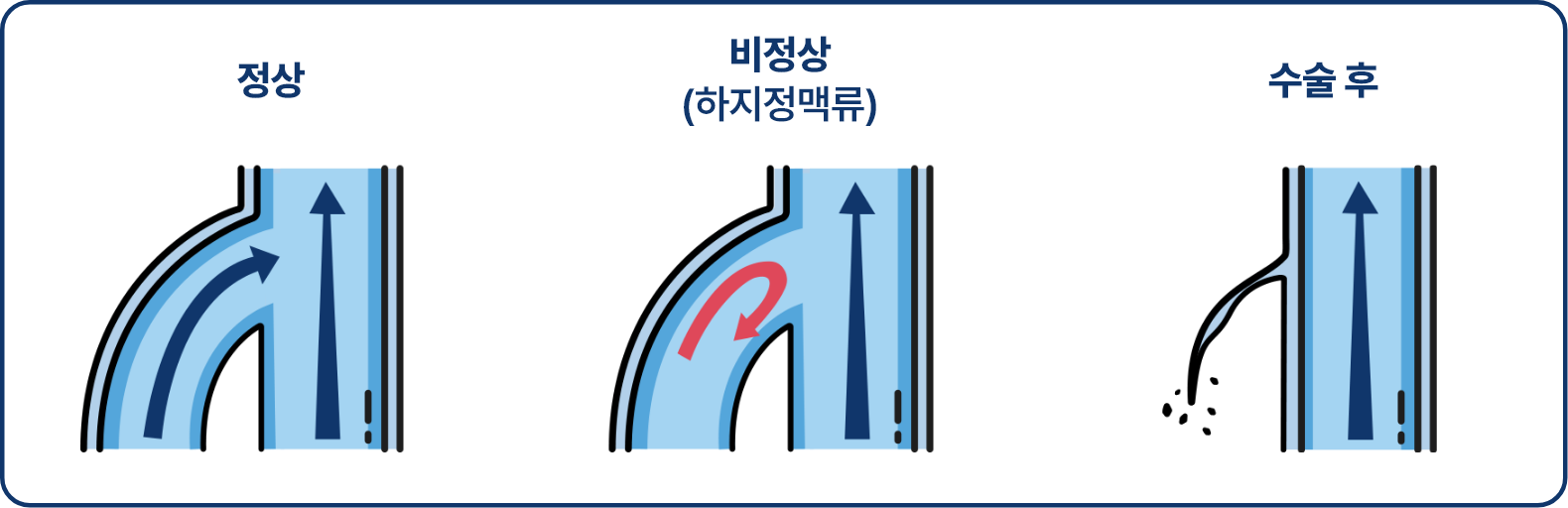 하지정맥류 맞춤치료 수술원리